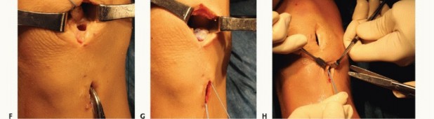 Illustration 29 for Symptomatic Knee? Meniscal Transplant for Anterior & Posterior Horns