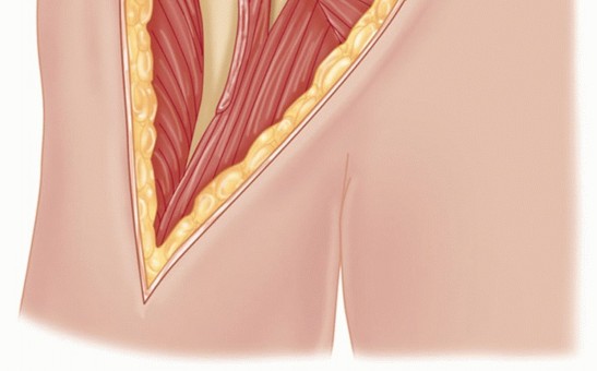 Illustration 17 for Irreparable Subscapularis Tears? Explore Pectoralis Major Transfer.