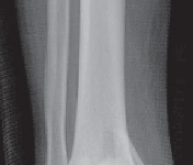 Illustration 14 for Optimizing ORIF for Tibial Plafond Fractures: A Modern Approach