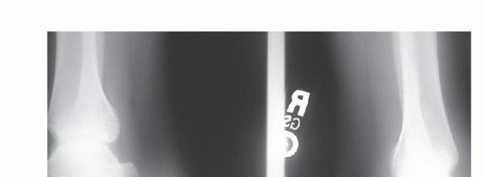 Advanced Treatment of Insertional Achilles Tendinosis: FHL Augmentation