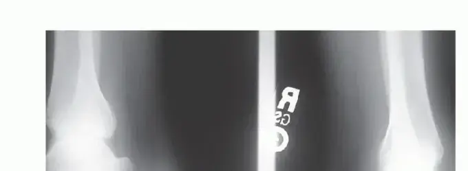 التهاب وتر أخيلس الإدخالي: دليلك الشامل للتخلص من آلام الكعب مع الدكتور محمد هطيف