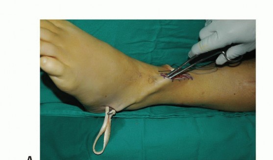 Illustration 47 for Foot Drop Surgery: How a Pin or Drill Elevates Tendon Transfer