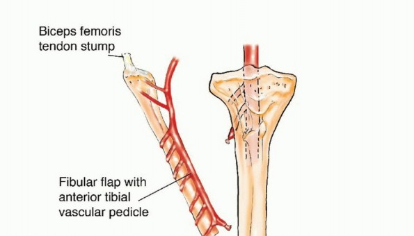 Illustration 6 for Free Vascularized Fibular Grafts: Solving Complex Bone Defects