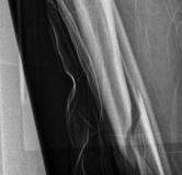 Illustration 14 for Tibial Fracture Extending into the Plafond: Intramedullary Secrets