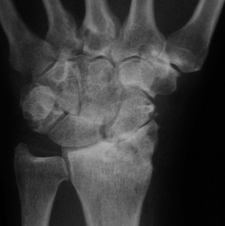 Illustration 16 for Christine M Kleinert Discussion: Solving Difficult Wrist Fractures