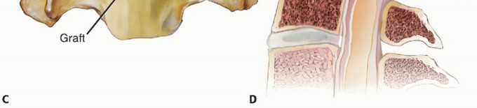 Illustration 34 for How ACDF Clears Your Posterior Disc Space for Lasting Relief