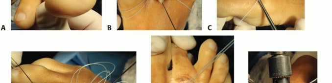 Illustration 41 for Plantar Plate Repair: End Lesser Toe Pain & Instability