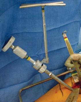 Illustration 33 for Mastering the Cementless Acetabular Cup: Techniques for Optimal Fixation