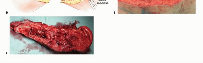 Illustration 44 for Mastering Femoral Metastases: Optimal Function for Femoris & Vastus