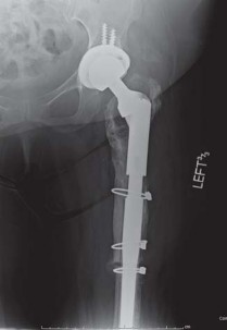 Illustration 45 for THA for patients with proximal femoral deformity: Practical solutions