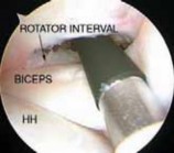 Illustration 10 for Capsular Releases for Loss of Motion: Restore Your Shoulder