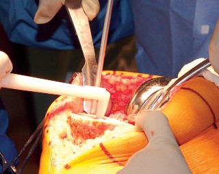 Illustration 61 for Mastering Gap Balancing in Revision TKA: Avoid Common Pitfalls