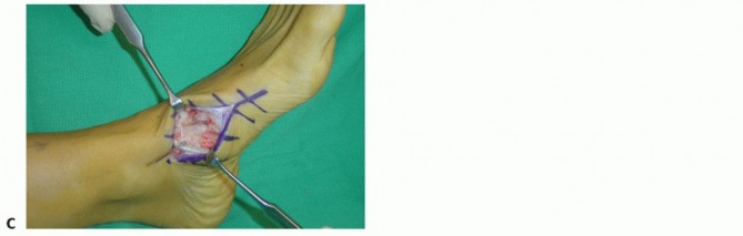 Illustration 58 for Mastering Midfoot Arthrodesis: Protect the Deep Neurovascular Bundle