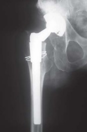 Illustration 38 for S-ROM: Inside the Technique of Modular Implant Design