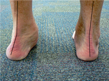 Illustration 101 for First Metatarsal Surgery: Expert Solutions for Foot & Ankle Pain