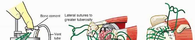 Illustration 28 for Hemiarthroplasty for Proximal: Effective Treatment for Fractures