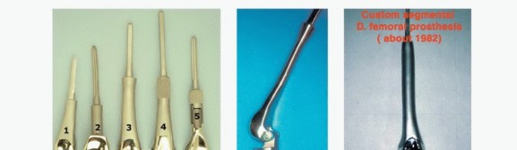Illustration 5 for Advanced Distal Femoral Resections: Limb-Sparing Outcomes & Techniques