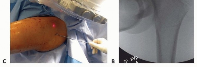 Illustration 10 for Pediatric Femoral Nailing: Targeting the Right aspect of the greater Trochanter