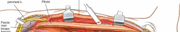 Illustration 102 for Surgical Access: Mastering the Tibia's Surface & Fibula Approaches