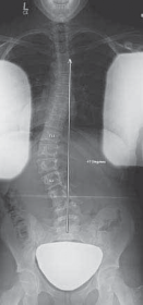 Illustration 8 for Mastering Anterior Interbody Arthrodesis with Instrumentation for Scoliosis