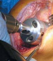 Illustration 20 for Knee Arthroplasty Unicondylar: Discover if Partial Knee Replacement is Right