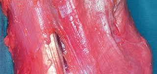 Illustration 23 for Mastering Valgus Total Knee Replacement: Techniques & Pitfalls