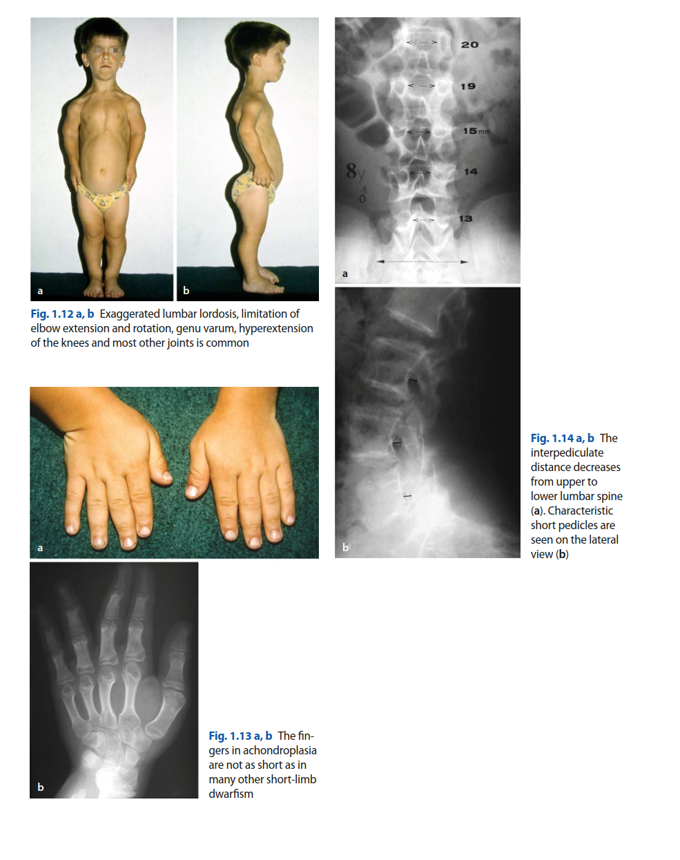 Illustration 3 for Orthopedic Cases Achondroplasia: Essential Insights & Management