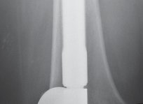 Illustration 69 for Mastering Gap Balancing in Revision TKA: Avoid Common Pitfalls