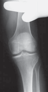 Illustration 3 for Knee Arthroplasty Unicondylar: Discover if Partial Knee Replacement is Right