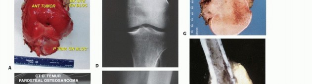 Illustration 39 for Understanding Benign Bone Tumors: Your Complete Preoperative Guide