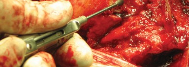 Illustration 44 for Figure Hip Resurfacing: Who Benefits and Who Should Avoid It?