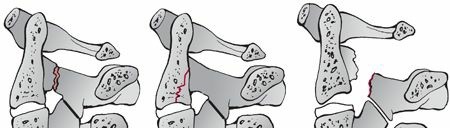 Illustration of spondylolisthesis of c - Dr. Mohammed Hutaif