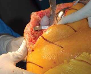 Illustration 30 for Mastering Gap Balancing in Revision TKA: Avoid Common Pitfalls