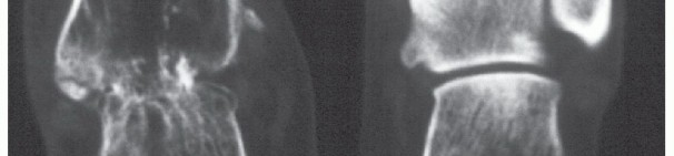 Illustration 4 for Beyond Amputation: Circular Fixation for Infection of the Talus