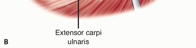 Illustration 14 for Radial Head Arthroplasty: Restoring Elbow Function & Stability