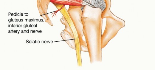 Illustration 11 for Surgical Pelvic Resection: Gluteus Maximus Muscle & Nerve Preservation