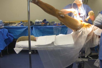 Illustration 7 for Metal on Metal Resurfacing: Enhanced Posterior Soft Tissue Repair