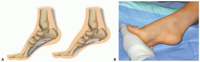 Illustration 15 for How Achilles Tendon Lengthening Fixes Equinocavovarus Foot