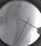 Illustration 13 for Increased Femoral Anteversion: A Proximal Femoral Rotational Osteotomy