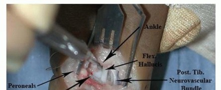 Illustration 8 for Resistant Clubfoot Solved: Posteromedial and Posterolateral Release