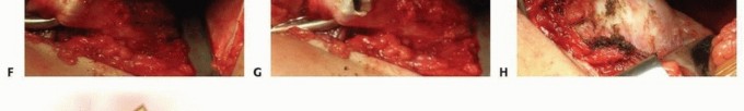 Illustration 14 for Mastering Anterior Open Reduction for Developmentally Dislocated Hip