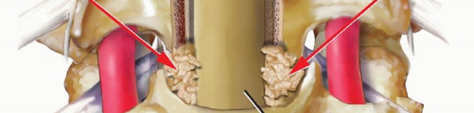 Illustration 18 for Stop Numbness & Instability: Corpectomy and Fusion Guide