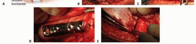 Illustration 21 for Mastering Anterior Open Reduction for Developmentally Dislocated Hip