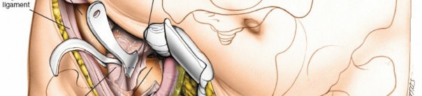 Illustration 77 for Pelvis & Acetabulum Approaches: Unlocking the Posterior Superior Iliac