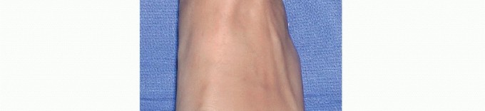 Ankle Arthroscopy: Achieving Precision Parallel to the Bimalleolar Axis