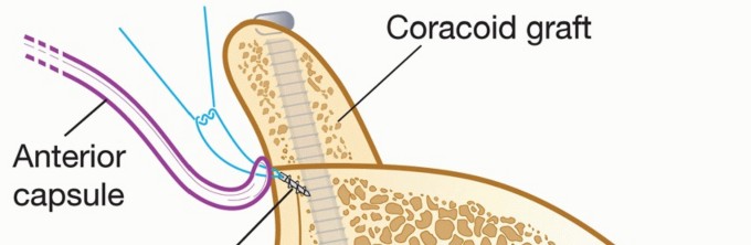 Illustration 28 for Latarjet for Instability: Bone Loss Solutions, Per Burkhart SS, Lo