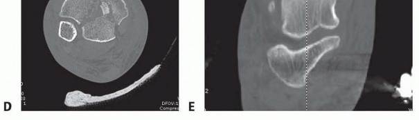 Illustration 19 for Tibia External Fixation: See How Pins Are Placed for Healing