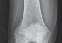 Minimize Pain, Maximize Recovery: TKA with Parapatellar