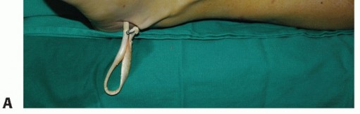 Illustration 49 for Restore Movement: Tendon Transfer for Common Peroneal Nerve Foot Drop