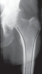 Illustration 14 for Cementless Femoral Stems: Master Indications & Avoid Pitfalls